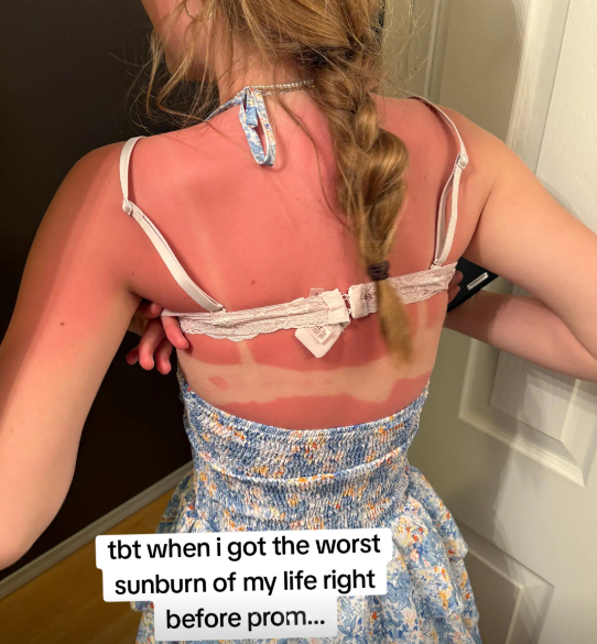 tbt when i got the worst sunburn of my life right before prom...