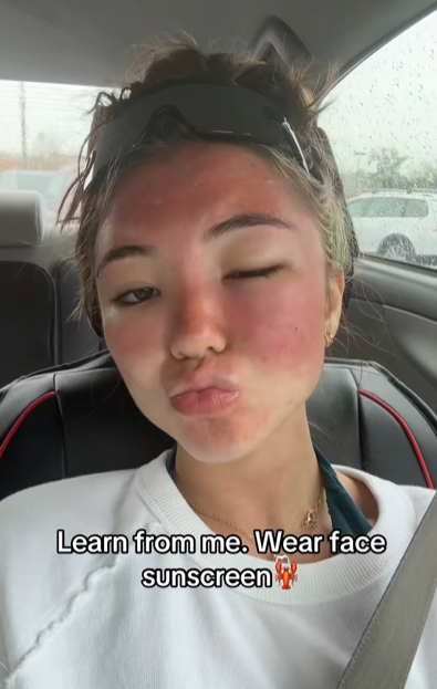 Learn from me. Wear face sunscreen