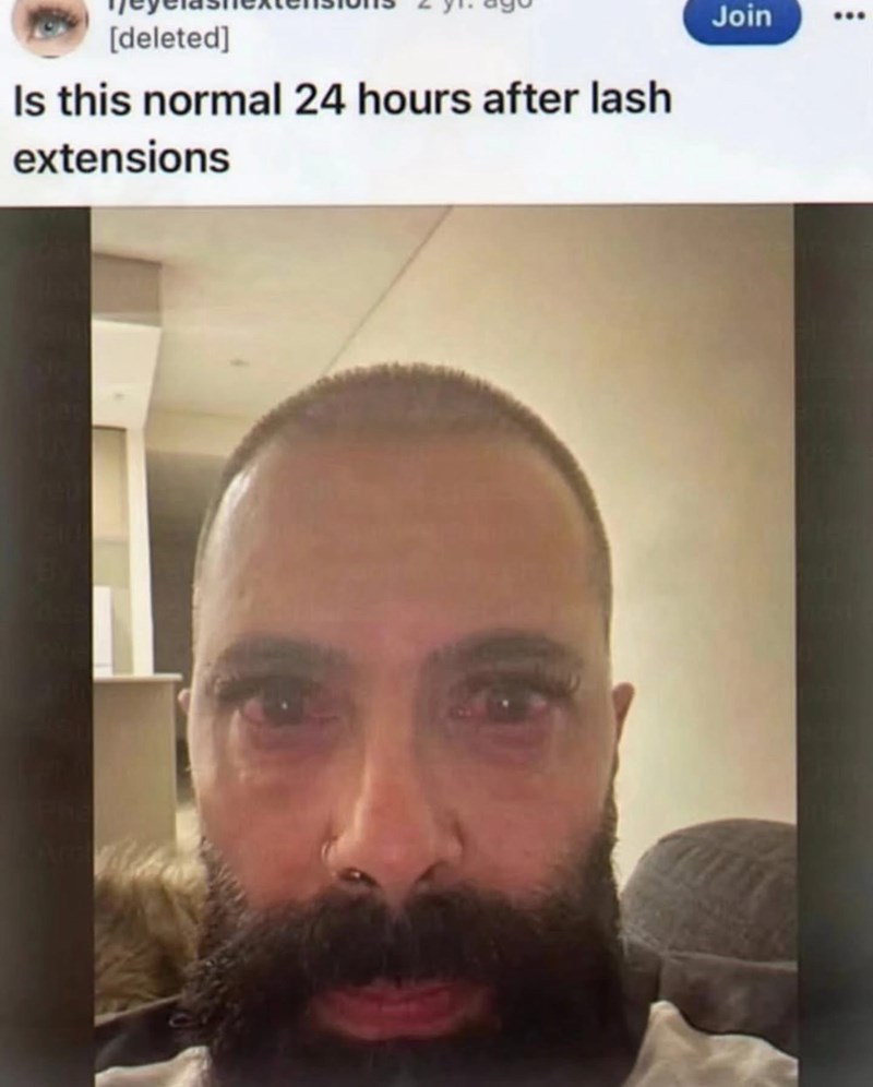 [deleted] Is this normal 24 hours after lash extensions Join