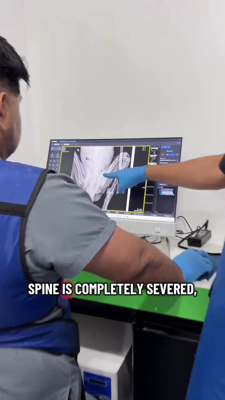 SPINE IS COMPLETELY SEVERED, MA