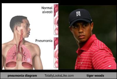 pneumonia diagram Totally Looks Like tiger woods