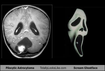Pilocytic Astrocytoma Totally Looks Like Scream Ghostface