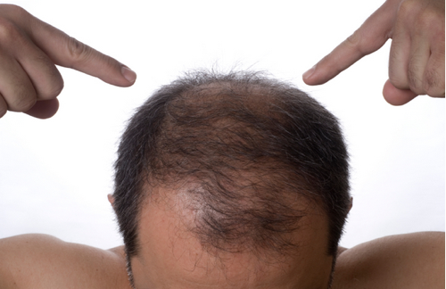 Baldness Breakthrough of the Day