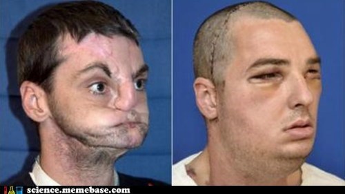 The First Full Face Transplant: A Stunning Success