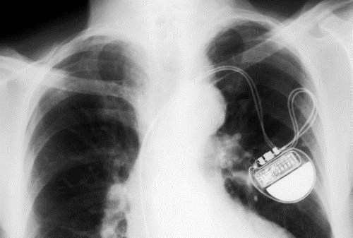 A Stopwatch in Your Chest! LOL Nope Just a Pacemaker