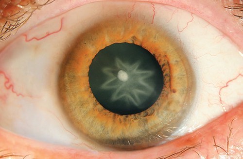Science Weird: Man Punched in the Eye Gains Star Shaped Cataract 