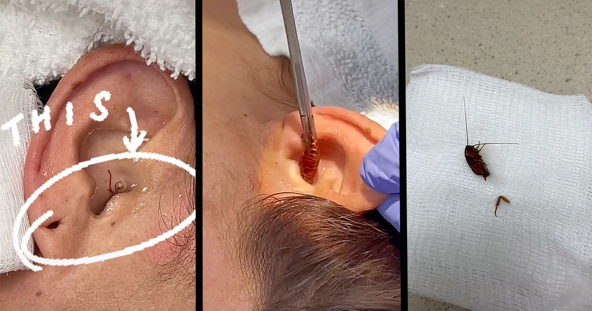 Woman Wakes Up to a Cockroach Crawling Inside of Her Ear, has to Get it ...