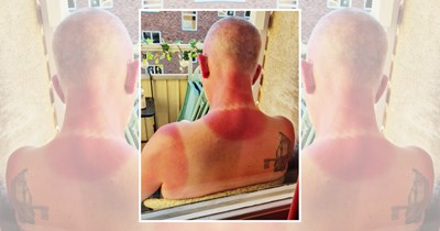 'Remember to wear sunscreen, kids!: 28 Sun burn fails so bad you will never forget to wear sunscreen again